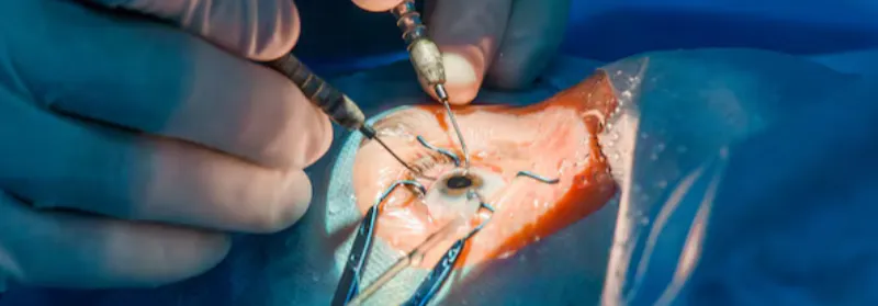 Cornea Transplant and Surgery in India