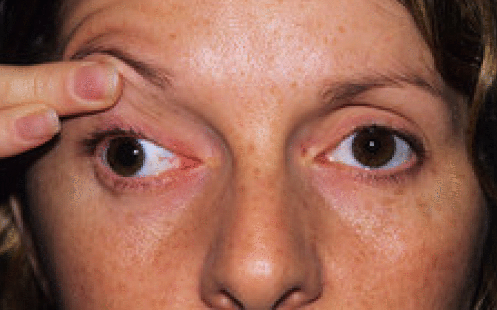 Oculomotor palsy