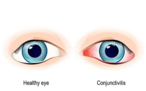 Conjunctivitis