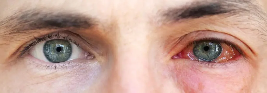 Emergecy Eye Hospital in Delhi