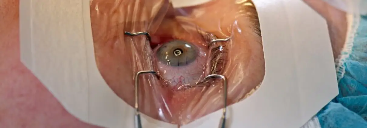 Retina Treatment in Delhi