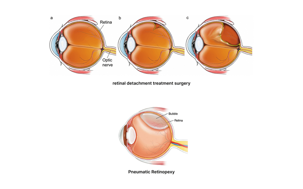 retinal detachment treatment surgery