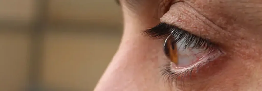 Keratoconus Treatment in Delhi