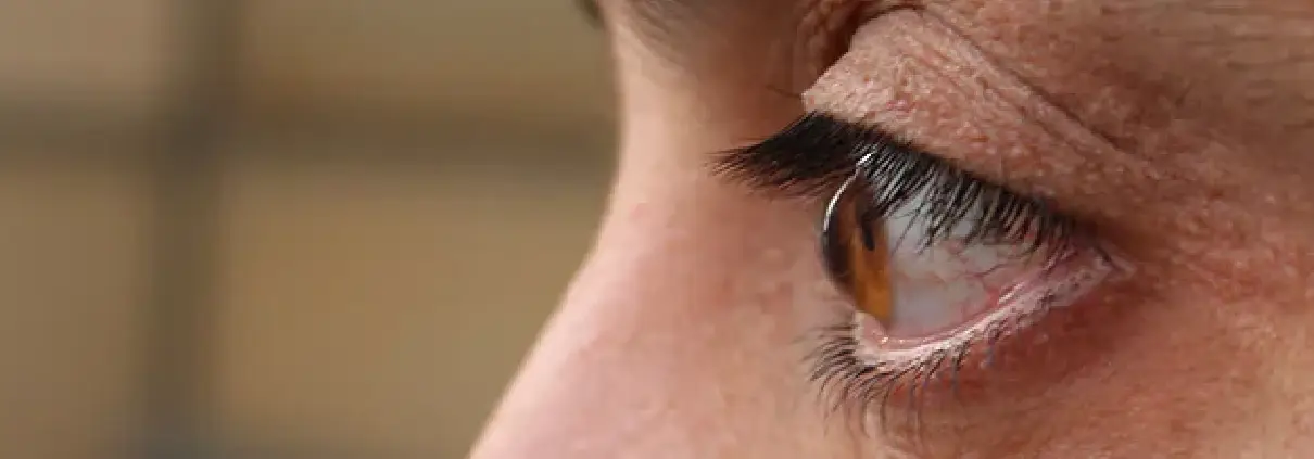 Keratoconus Treatment in Delhi