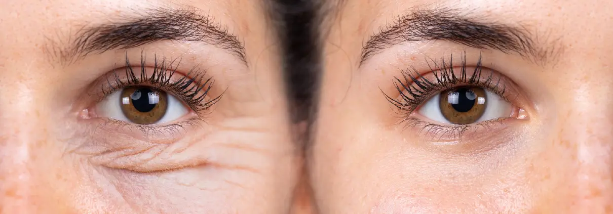 Oculoplasty & Cosmetic Eye Surgery in Delhi