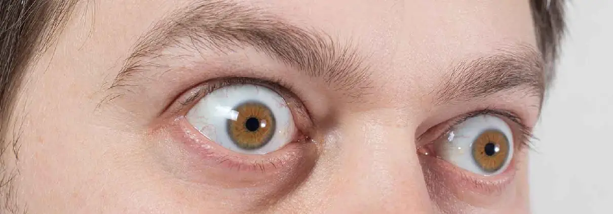 Thyroid Eye Disease Treatment