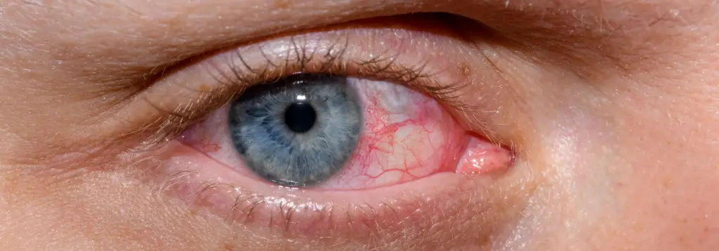 Dry-Eye Syndrome-and-Symptoms