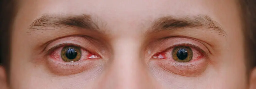 Red-Eyes-Causes-and-Symptoms