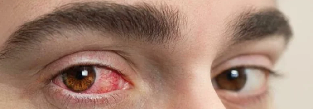 How-Eye-Flu-Spreads