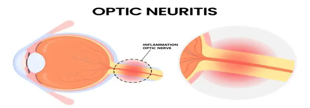Optic_Neuritis