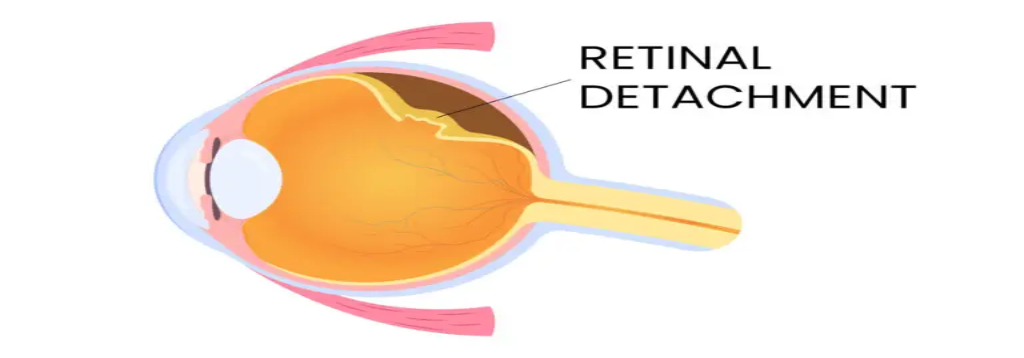 Retinal Detachment