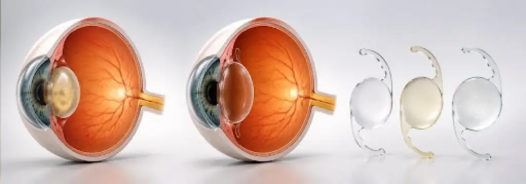 cataract-surgery-delhi